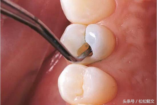 蛀牙为什么要治很多次,牙齿蛀牙高发如何有效预防和治疗