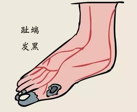 男子抽20年烟三根脚趾坏死,男子抽烟20年脚趾坏死