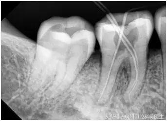 有多少人接受过根管治疗,一分钟带你了解根管治疗