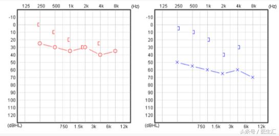 听力低频下降怎么恢复,低频听力下降耳鸣怎么治疗