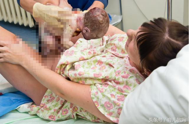 剖宫产会感染妇科病吗,剖宫产对宝宝的身体健康有危害吗