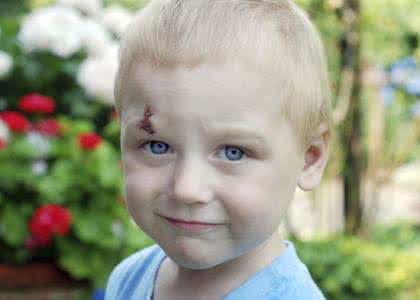 这些行为影响宝宝听力家长要注意,如果孩子得了白斑家长该怎么面对