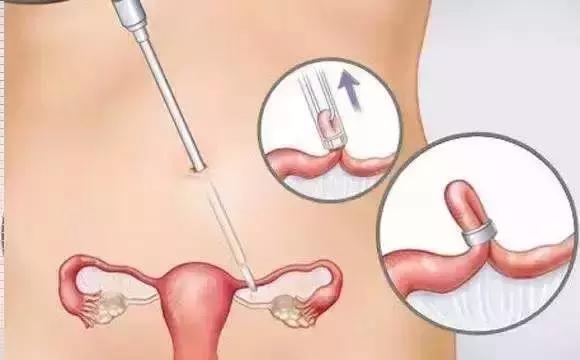 下周就是七夕!现在开始吃避孕药还来得及吗?