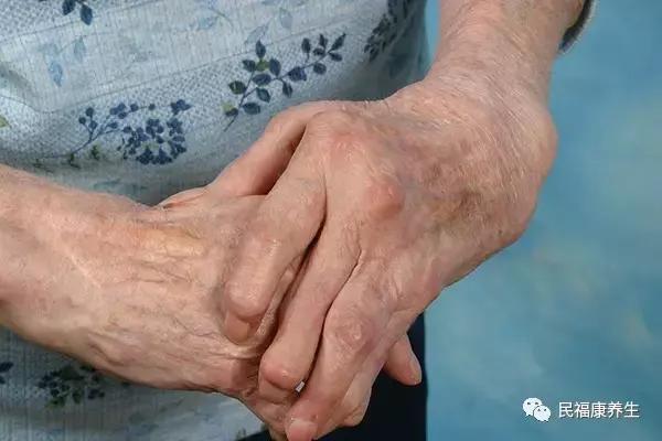 白癜风初期症状怎么辨别,白癜风早期自己怎样判断