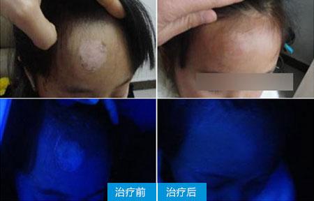 彻底治愈白癜风的最佳方法,治白癜风的偏方快速治好白癜风