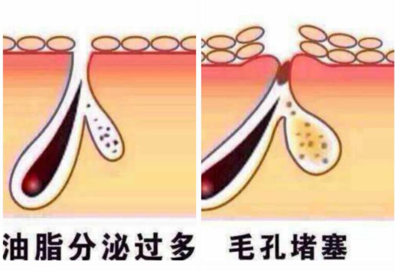 毛孔粗大去医院能治好吗,毛孔粗大可以去医院治吗