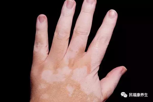 白癜风初期症状怎么辨别,白癜风早期自己怎样判断