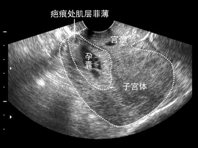 瘢痕子宫怀孕会子宫破裂吗,剖腹产的子宫都是瘢痕子宫吗
