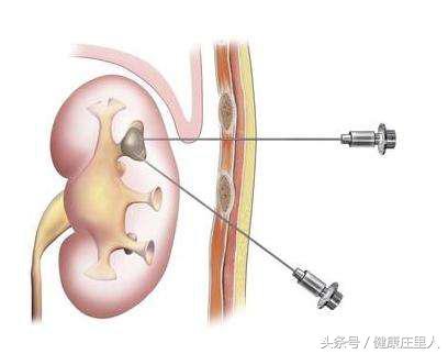 肾穿刺并非金科玉律,它可能会造成严重后果