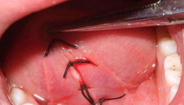 一岁多宝宝舌头w型正常吗,一岁半宝宝舌头伸出来竟是w型