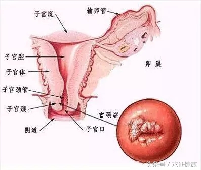 关于宫颈癌疫苗的基础知识,关于宫颈癌疫苗的知识