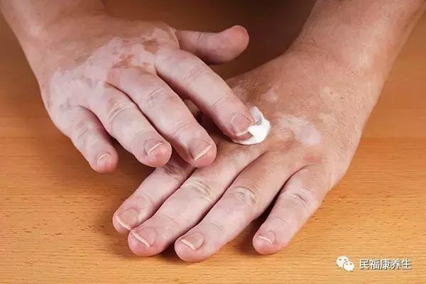 白癜风初期症状怎么辨别,白癜风早期自己怎样判断