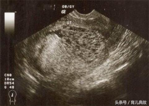 怀孕五月却检查出葡萄胎,这种心痛有谁能懂?