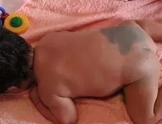 出生时的胎记有可能是黑色素瘤,儿童胎记切除