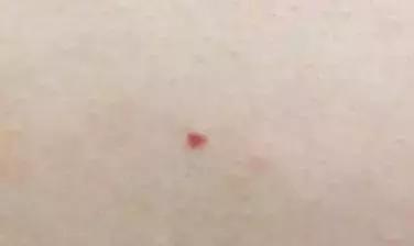身上长小红痣是什么病的前兆,身上越长越多小红痣什么原因