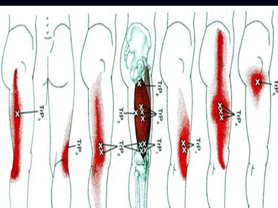 膝关节骨性关节炎的阶梯治疗课件,膝关节炎的非手术疗法