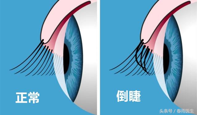 眼睛里面有刺痛感痒怎么回事,小朋友眼睛痒痒总是揉是怎么回事