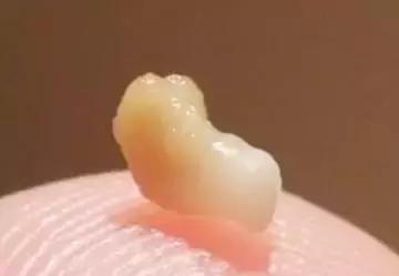 口臭咳嗽有白色颗粒怎么回事,咳出小黄粒恶臭味导致口臭