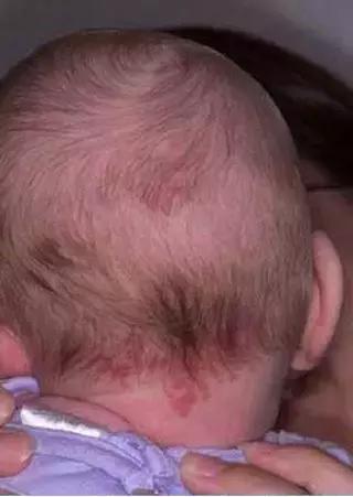 出生时的胎记有可能是黑色素瘤,儿童胎记切除