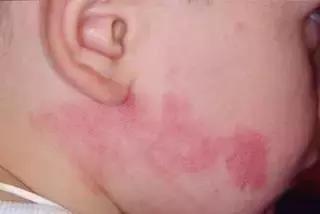 出生时的胎记有可能是黑色素瘤,儿童胎记切除