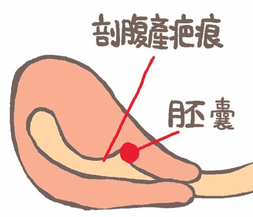 瘢痕子宫怀孕会子宫破裂吗,剖腹产的子宫都是瘢痕子宫吗