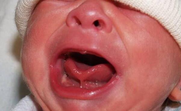 一岁多宝宝舌头w型正常吗,一岁半宝宝舌头伸出来竟是w型