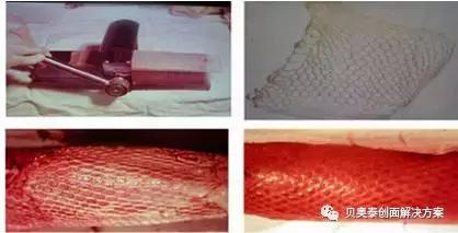 烧伤的治疗,烧伤的治疗土方