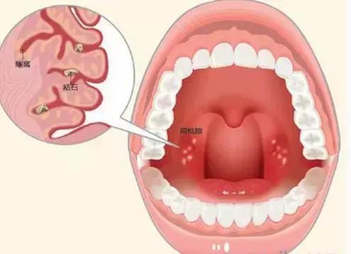 口臭咳嗽有白色颗粒怎么回事,咳出小黄粒恶臭味导致口臭