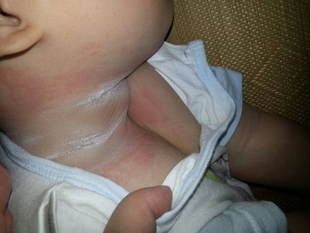 夏天宝宝的脖子很容易淹，千万不要再擦干粉，这几个小妙招很管用