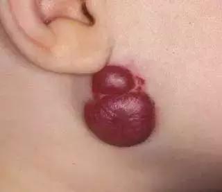 出生时的胎记有可能是黑色素瘤,儿童胎记切除