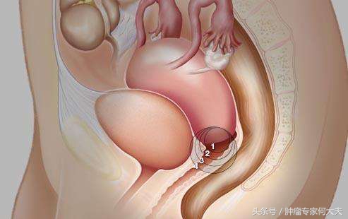 32岁的她如今怎样了,宫颈癌晚期活了50年的真实案例