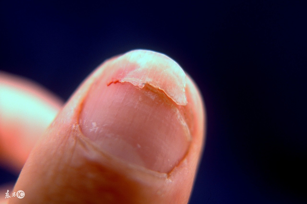 发现有灰指甲的预兆怎么防治,灰指甲是怎么引起的可以治愈吗