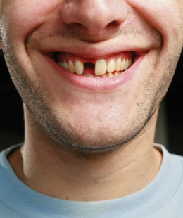 门牙缺失可以做牙冠吗,门牙缺失能种植牙吗