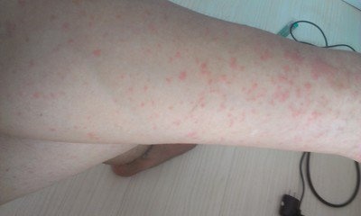 用什么方法治湿疹不再犯,治湿疹天然方法