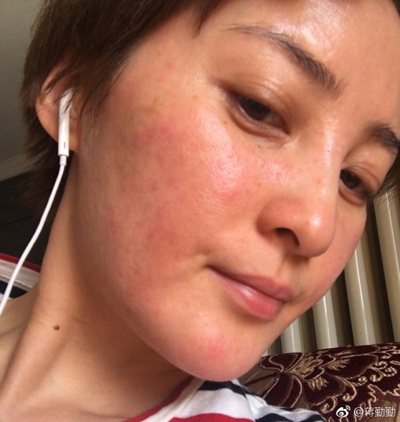 蒋勤勤皮肤过敏,蒋勤勤过敏怎么治疗