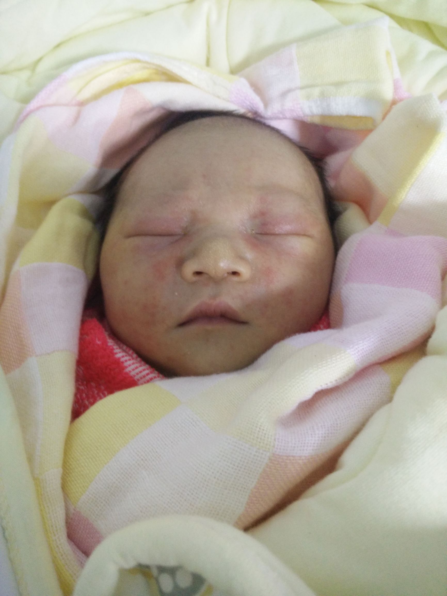 宝宝湿疹妈妈很着急,宝宝湿疹的正确防治方法