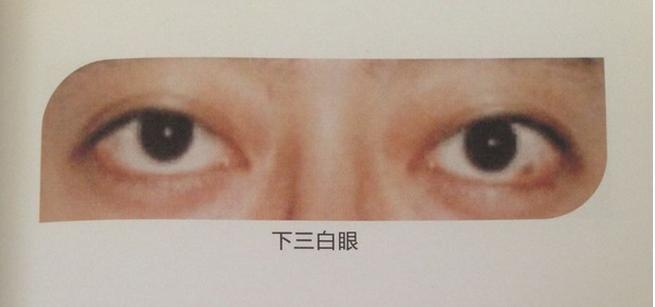 “三白眼”:看到这样的眼睛,男子慌张转身便逃!