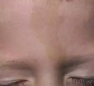 出生时的胎记有可能是黑色素瘤,儿童胎记切除