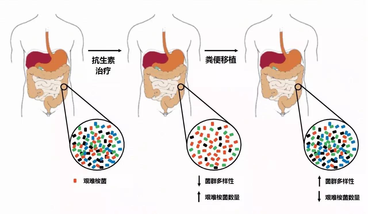 你狠心冲掉的便便，正成为许多肠胃病人的救星