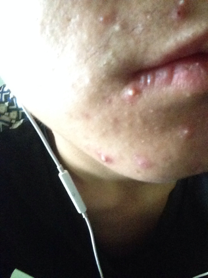 嘴周围发红长痘痘是什么原因,戴口罩嘴周围长痘痘怎么办