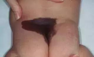 出生时的胎记有可能是黑色素瘤,儿童胎记切除