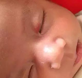 出生时的胎记有可能是黑色素瘤,儿童胎记切除