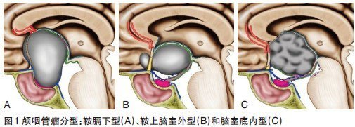 绕过这些弯路,治疗颅咽管瘤没那么难