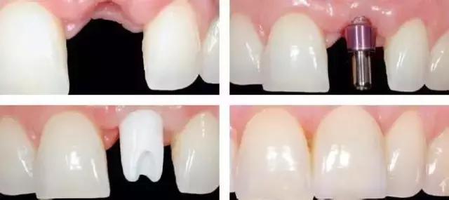 门牙缺失可以做牙冠吗,门牙缺失能种植牙吗