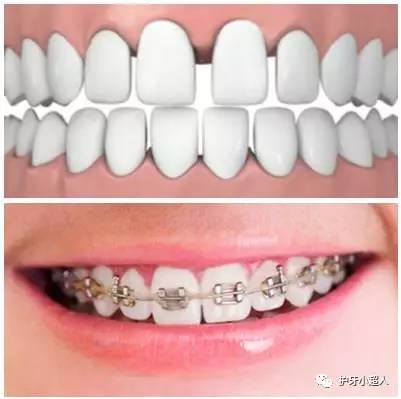 50岁牙缝变大怎么修复,牙缝变大吃什么药能修复