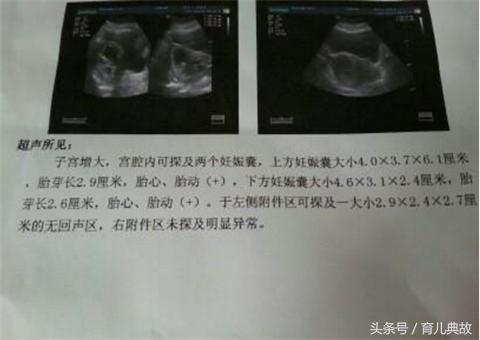 和老公感情不好怀了双胞胎,怀双胞胎老公不想要怎么办
