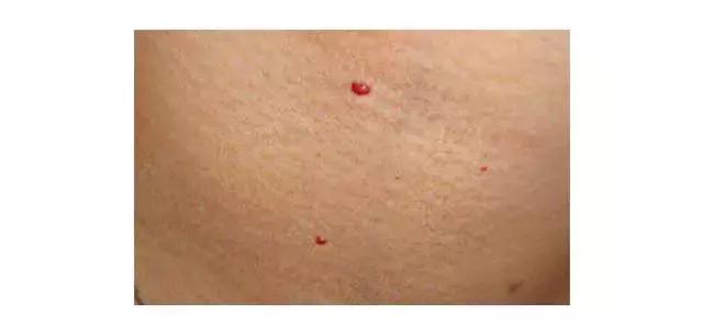 出现小红痣不痛不痒,60岁身上现小红痣是什么原因