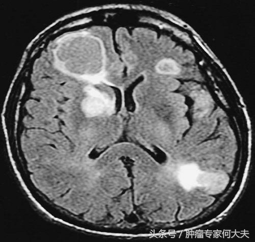 肺癌骨转移活了10年,肺癌脑转移骨转移活了10年