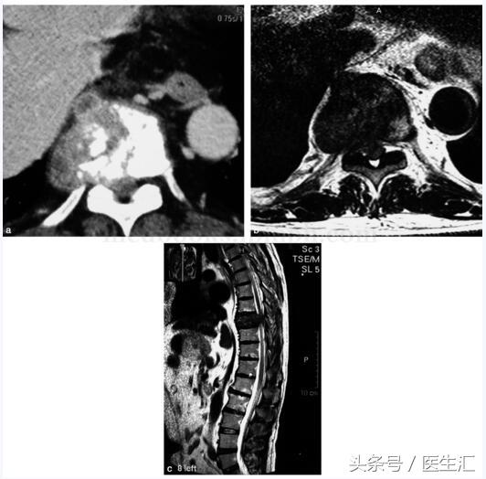 癌症脊柱骨转移怎么治疗,脊柱转移恶性肿瘤的最佳治疗方法
