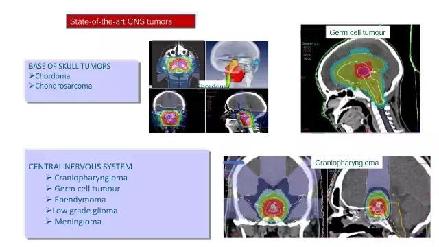 演讲PPT/法国居里研究所皮埃尔贝：儿童神经肿瘤的质子放疗